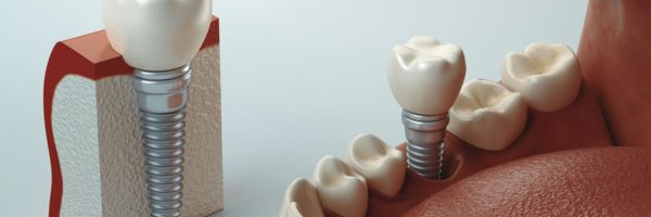 2020-06-cuidados-pos-operatorio-para-a-cirurgia-de-implante-dentario-1280x720