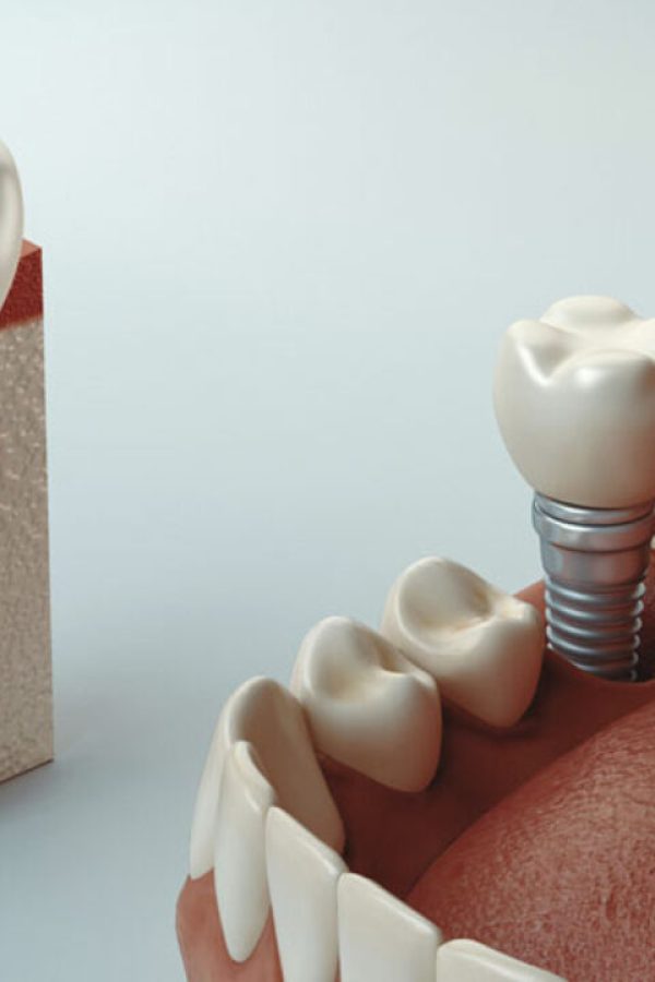 2020-06-cuidados-pos-operatorio-para-a-cirurgia-de-implante-dentario-1280x720