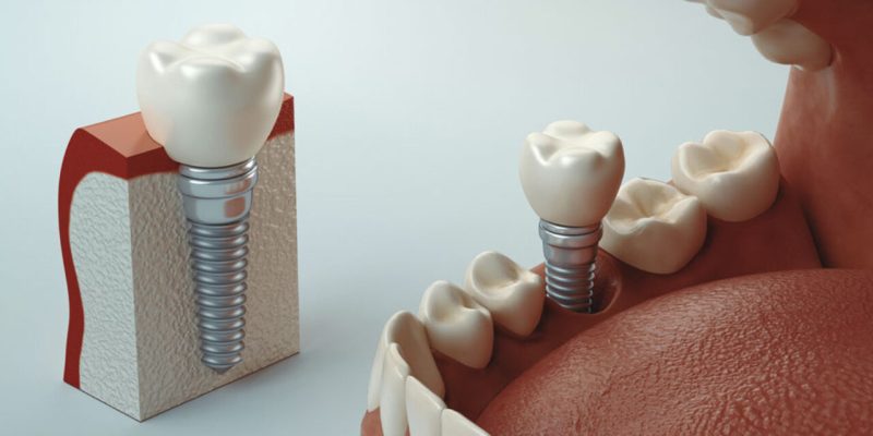 2020-06-cuidados-pos-operatorio-para-a-cirurgia-de-implante-dentario-1280x720